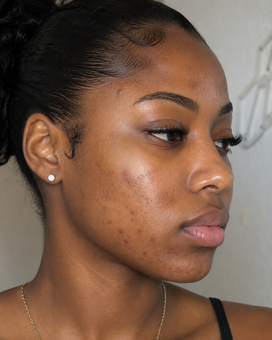 Before acne and texture treatment